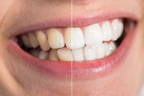 How A Smile Makeover Can Improve Your Teeth